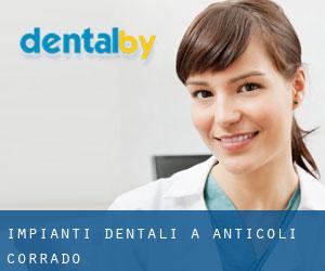 Impianti dentali a Anticoli Corrado